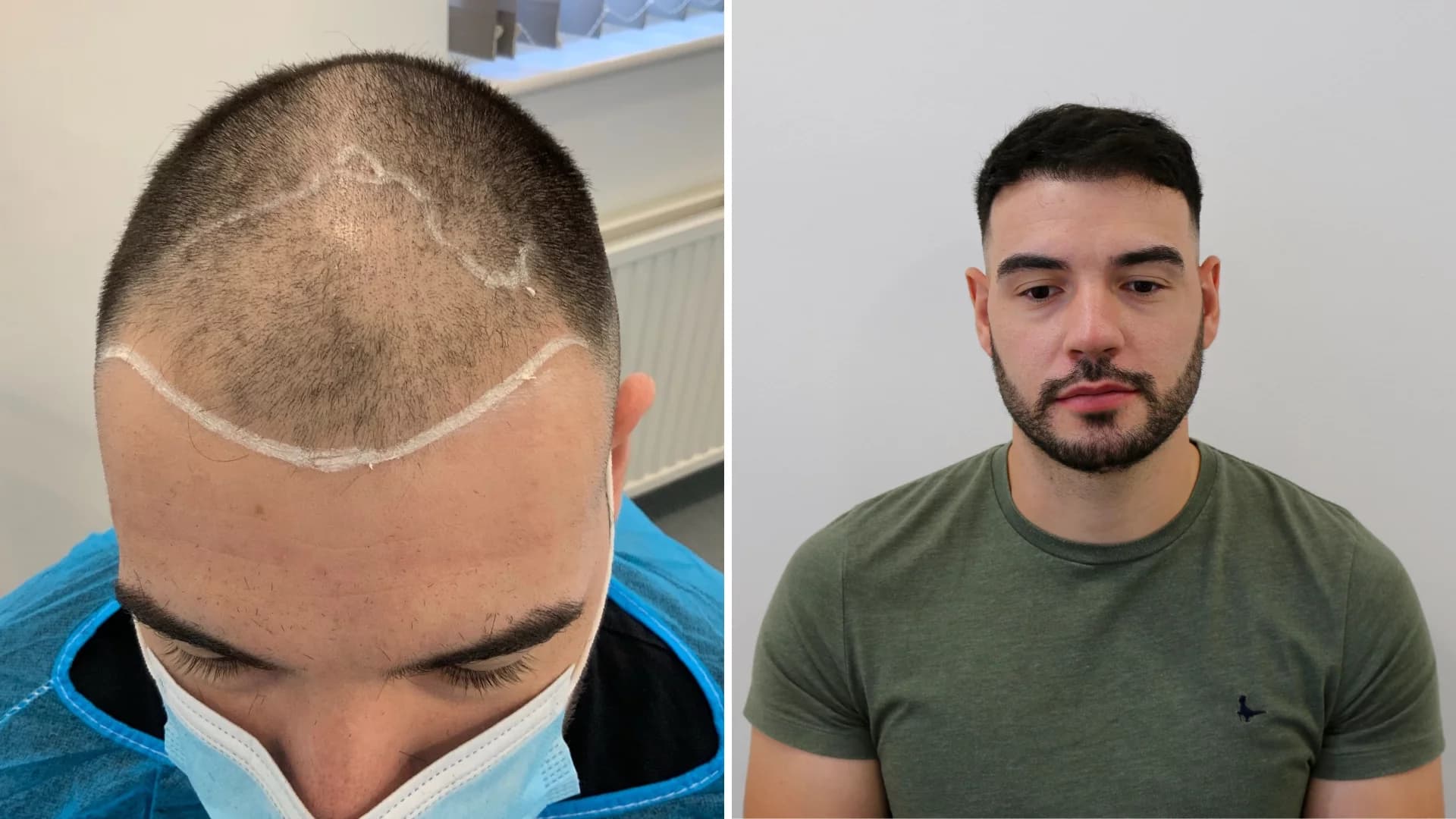 Hair Transplant UK – Natural Results with Leading Specialists